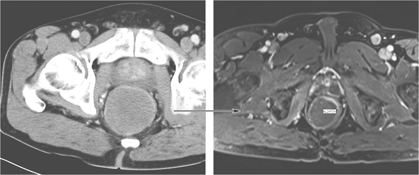 图3 伊马替尼治疗8个月后复查增强MRI